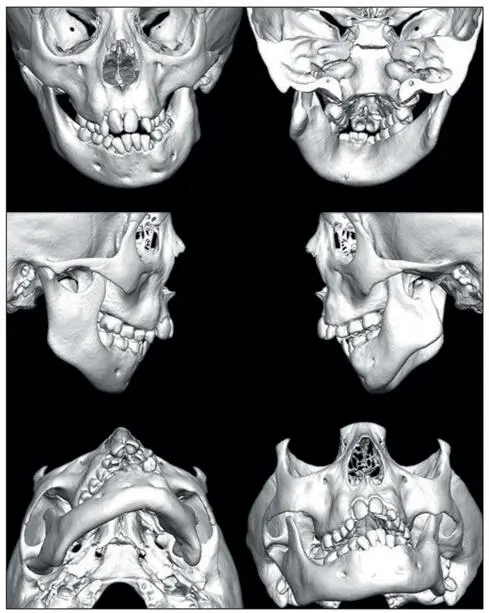 Fig 271The 3D CT scanned image of a patient with hemifacial microsomia The - фото 138
