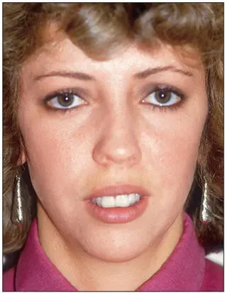 Fig 218Excessive maxillary incisor exposure and increased interlabial gap - фото 68