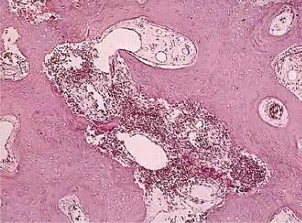 FIG 118Histomorphometry of an autogenous bone graft without PRP at 4 months - фото 28