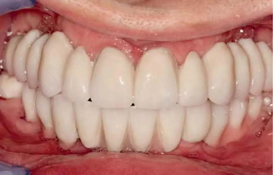 Fig 27kA fixed temporary restoration for the correction of the VDO Fig - фото 45