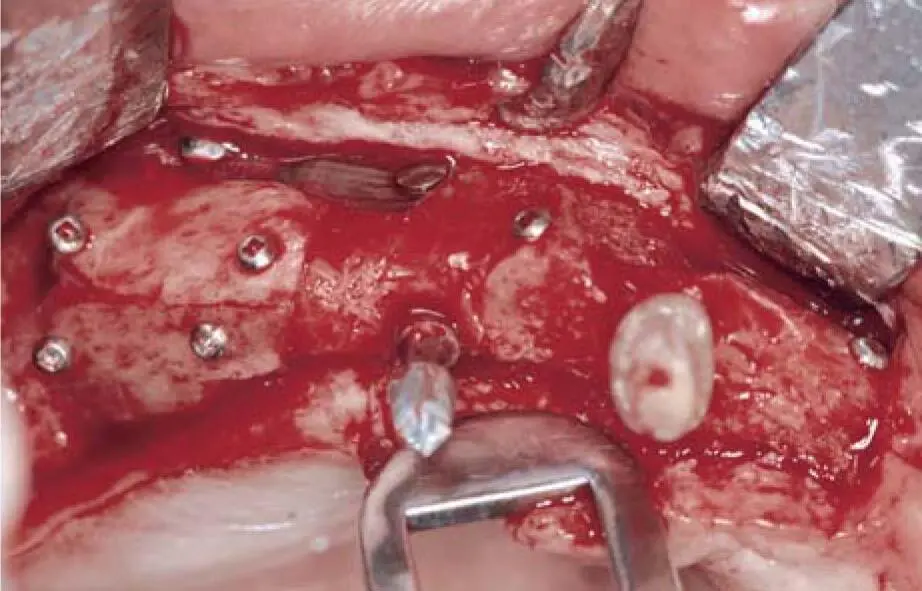 Fig 226cClinical situation of the vertical grafted bone in the right maxilla - фото 142