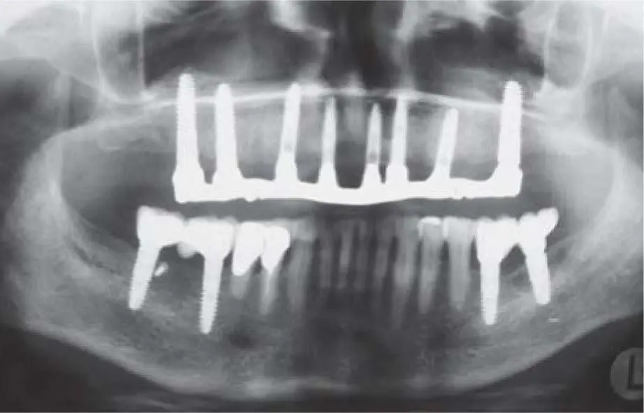 Fig 225dRecall radiograph 2 years postoperatively with implants that show good - фото 138