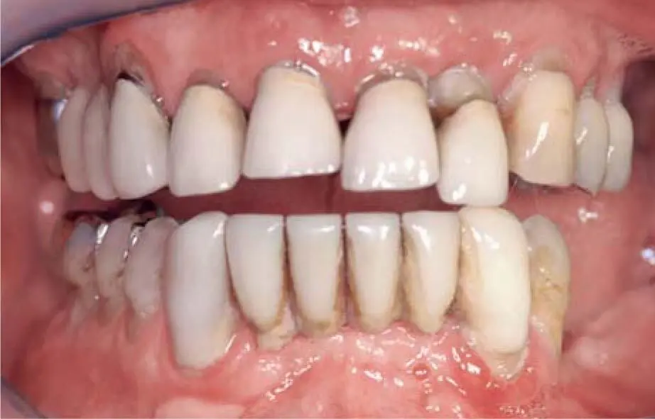 Fig 226aSevere periodontal disease with many mobile teeth Fig 226bMultiple - фото 140