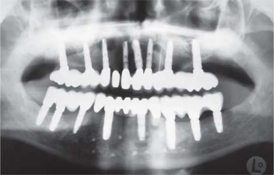 Fig 226dControl radiograph 7 years postoperatively Fig 226eClinical - фото 143