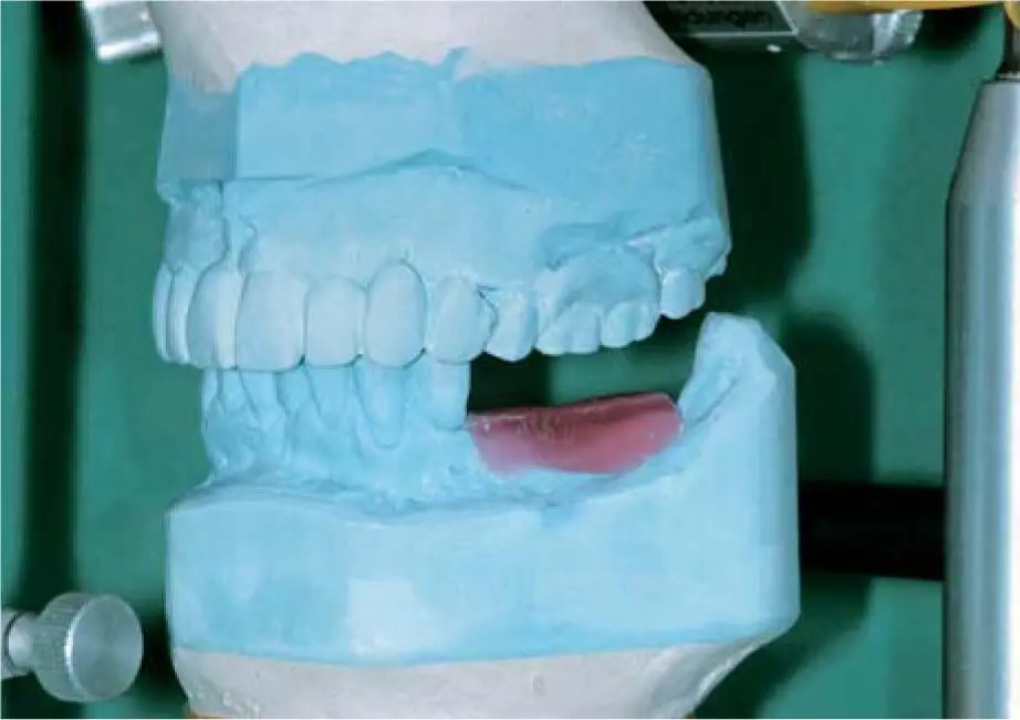 Fig 222cSimulation of the necessary grafting volume in wax Fig 222dWaxup - фото 121