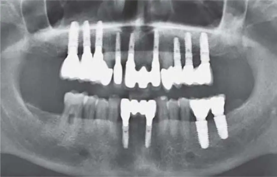 Fig 224cControl radiograph 7 years postoperatively with a stable periimplant - фото 133