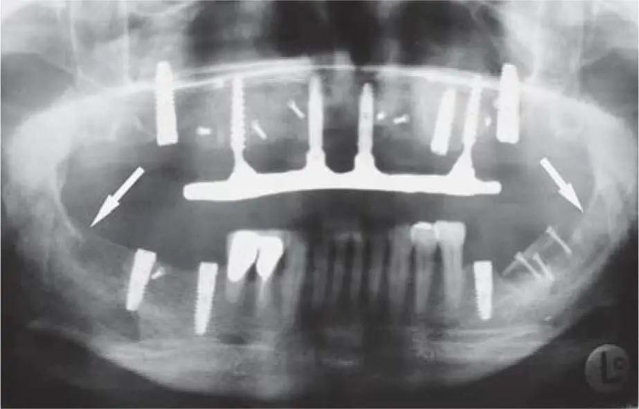 Fig 225cTwo donor sites in the retromolar area of the right and left mandible - фото 137