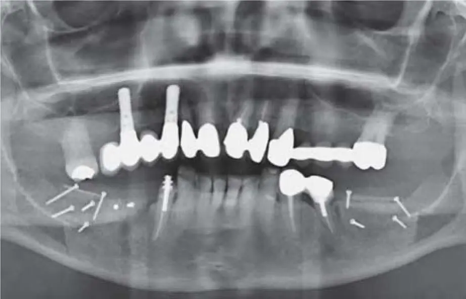 Fig 222ePanoramic radiograph documenting a bilateral vertical bone - фото 123