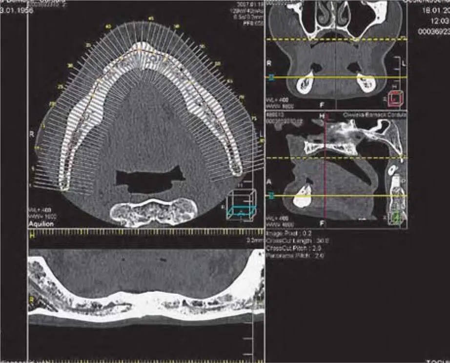 Fig 217cCT images of the mandible in the context of augmentation planning the - фото 80