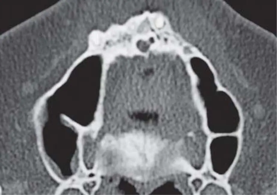 Fig 217hThe same septa in the middle of both maxillary sinuses Cone beam - фото 85
