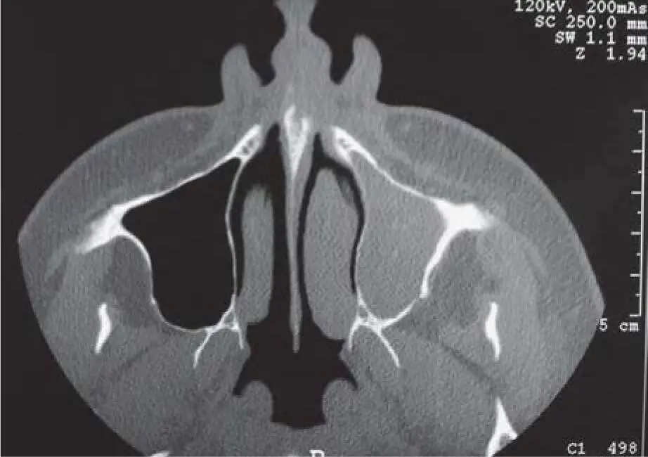 Fig 218dThe maxillary left sinus is also completely shadowed in this image - фото 89