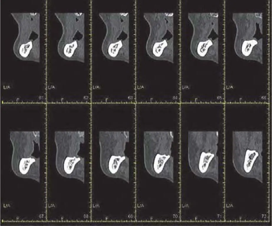 Fig 217eMultiple slices from the posterior region of the mandible Fig - фото 82