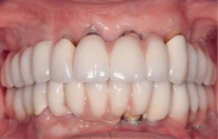 Fig 226gClinical appearance 17 years postoperatively with poor oral hygiene - фото 146