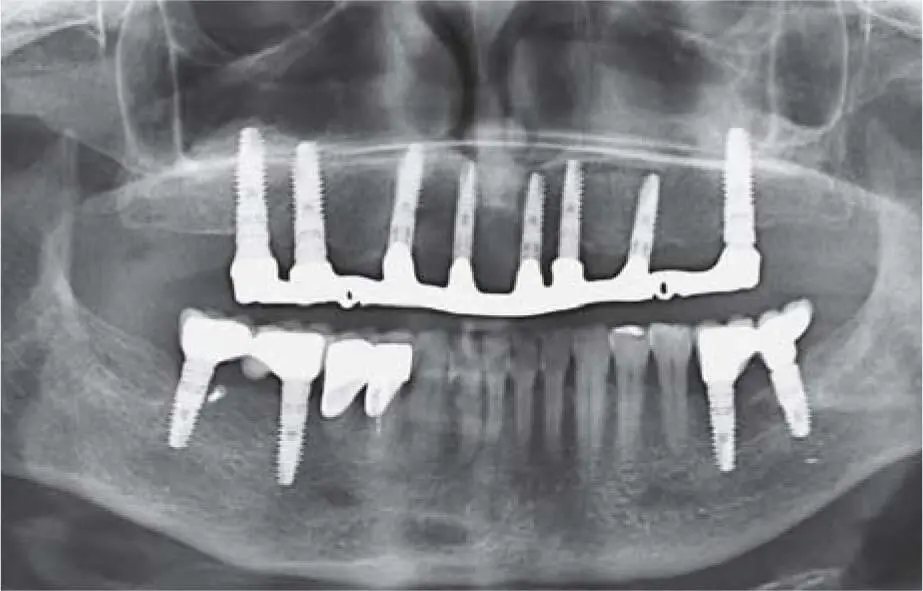 Fig 225eControl radiograph 12 years postoperatively Fig 226aSevere - фото 139