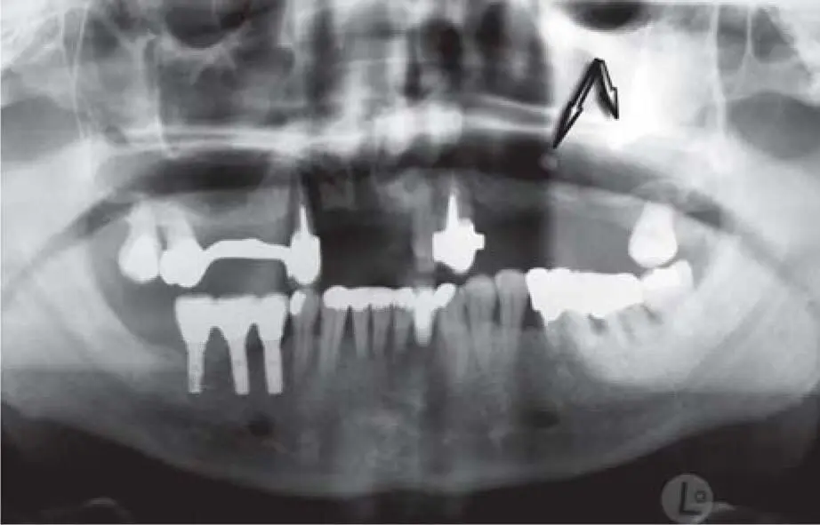 Fig 218aPanoramic radiograph showing two foreign bodies suspected to be - фото 86