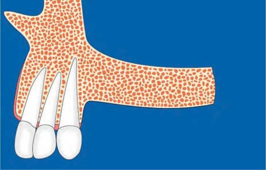 Fig 223aSchematic illustration of a class C vertical bone defect according to - фото 125