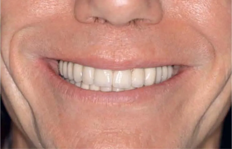 Fig 226fThe long upper lip covers the pink ceramic and the cleaning canals - фото 145
