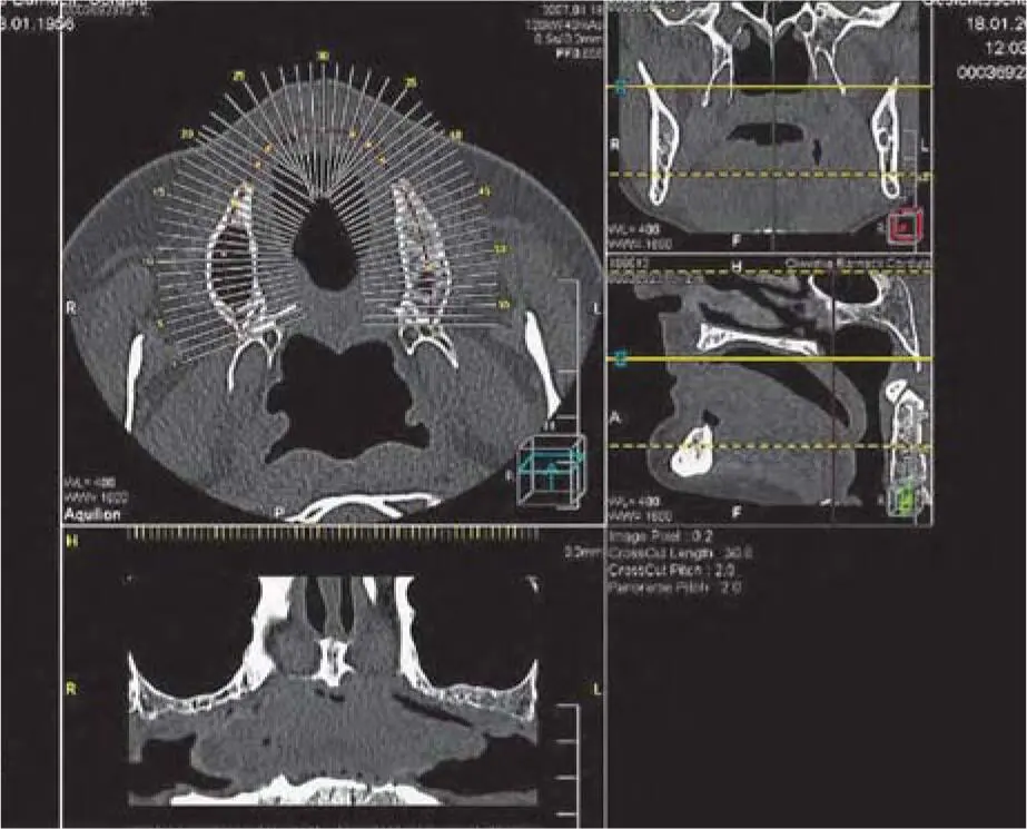 Fig 217dCT images of the maxilla with the same thickness Fig 217eMultiple - фото 81