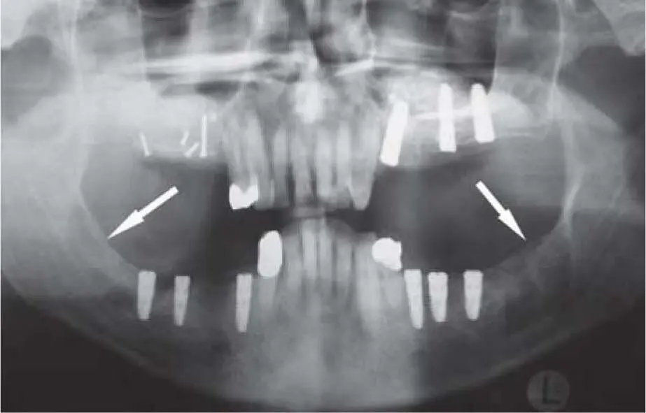 Fig 225aTwo donor sites in the retromolar area of the right and left mandible - фото 135