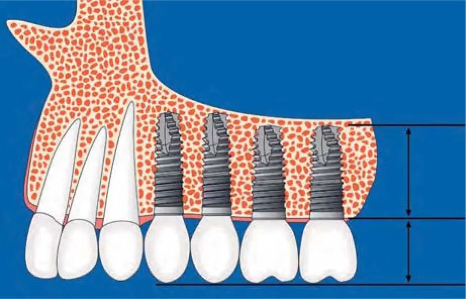 Fig 223dSchematic illustration of implants placed after vertical - фото 128