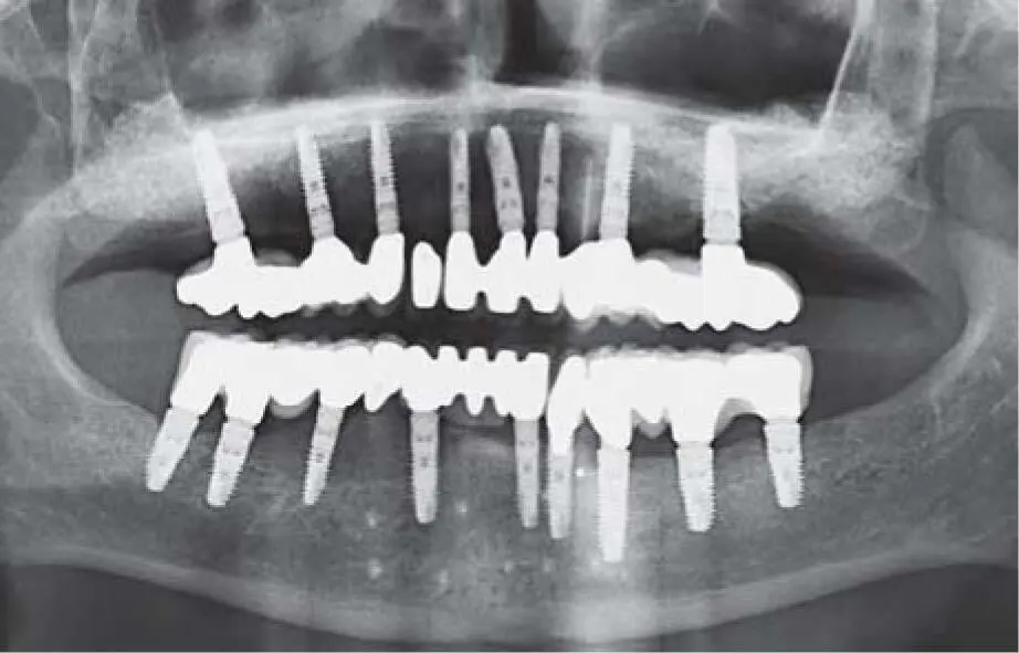 Fig 226hControl radiograph 17 years postoperatively Only in exceptional - фото 147
