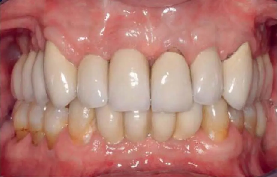 Fig 224dClinical situation 7 years postoperatively 2513 Multiple - фото 134