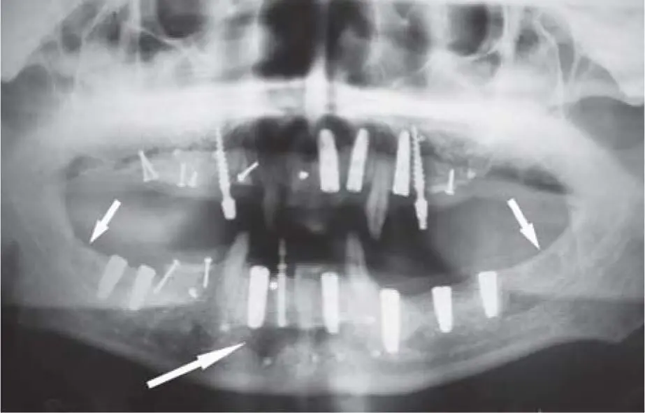 Fig 226bMultiple bone grafting in various areas of the maxilla and mandible - фото 141