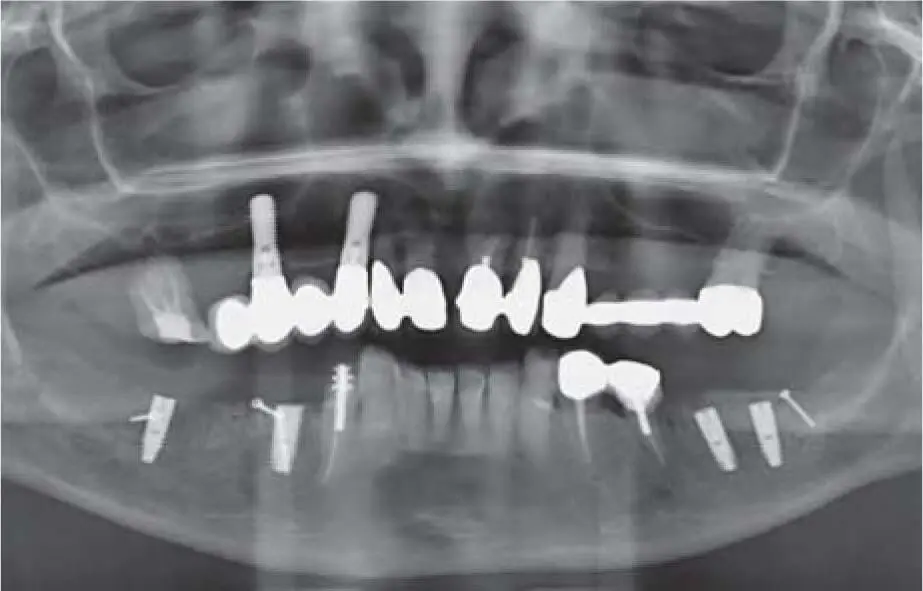 Fig 222fPanoramic radiograph documenting the implant insertion after reducing - фото 124
