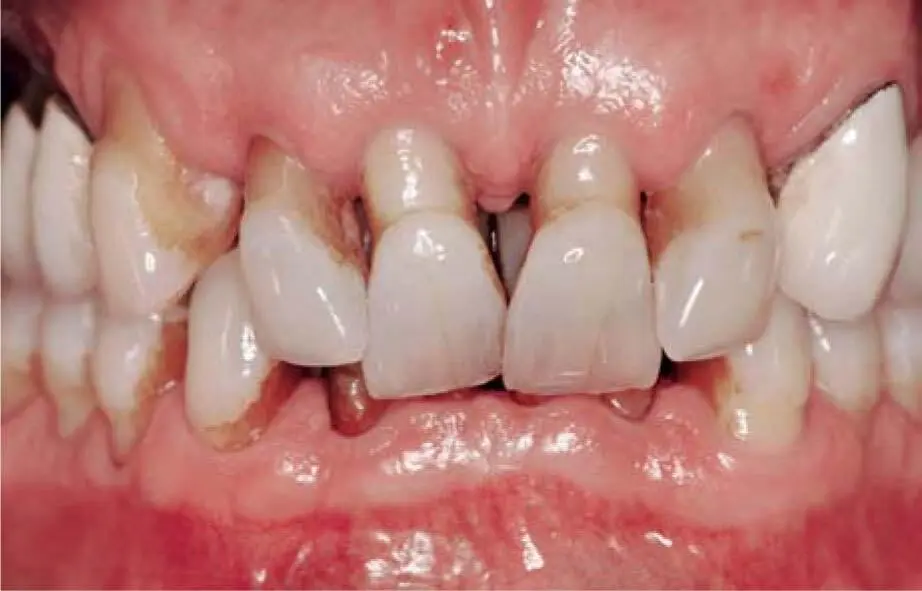 Fig 224aClinical situation before treatment closed bite and severe - фото 131