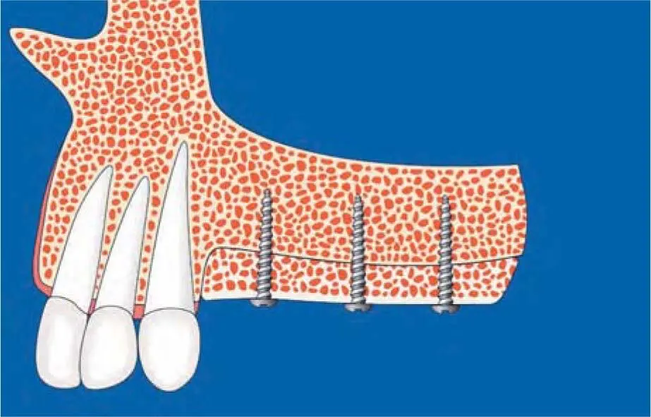 Fig 223cSchematic illustration of vertical grafting in a class E defect to - фото 127