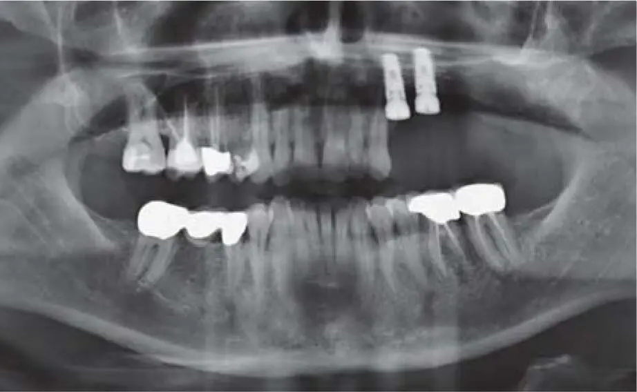 Fig 223fPanoramic radiograph documenting the extreme apical position of the - фото 130
