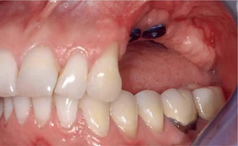 Fig 223eIncorrect implant insertion in the posterior left maxilla Fig - фото 129