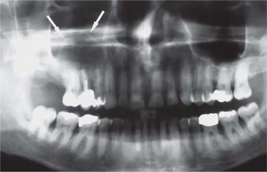 Fig 217aPanoramic view with suspected cystic findings in the right sinus - фото 78