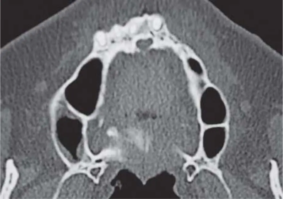 Fig 217gImportant septa in the basal area of both maxillary sinuses Fig - фото 84