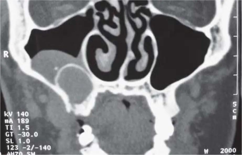 Fig 217bCT scan with clarification of the findings maxillary cyst with - фото 79