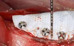 Fig 122 Labial view of a dense membrane fixated around a chronic vertical - фото 27