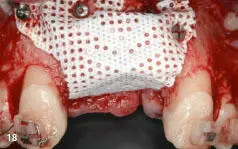 Figs 216 to 218 Vertical augmentation of the anterior maxilla - фото 75