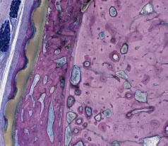Fig 13 The membrane shows signs of osseointegration on both sides Note the - фото 8