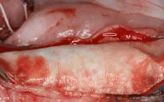 Fig 131 Labial view of a perforated membrane covered with a collagen membrane - фото 36