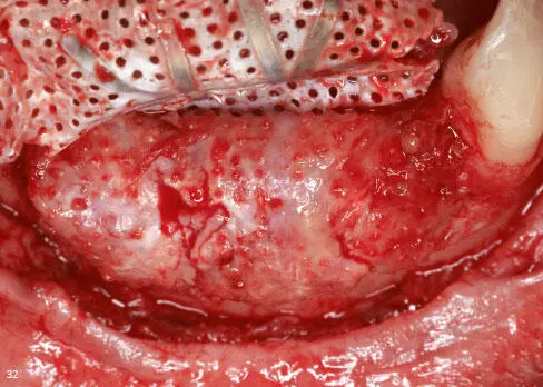 Figs 230 to 234 Vertical augmentation of the anterior mandible - фото 89
