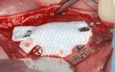 Fig 129 Labial view of a fixated dense membrane Fig 130 Labial view of a - фото 34