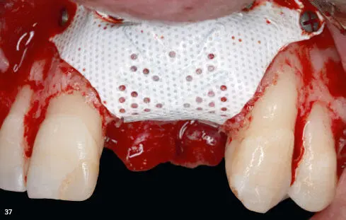 Figs 235 to 239 Vertical augmentation of the anterior maxilla - фото 94