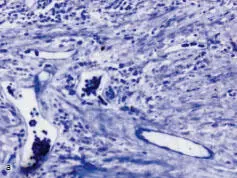 Fig 135a and b The perforated group demonstrated a tendency toward better - фото 40