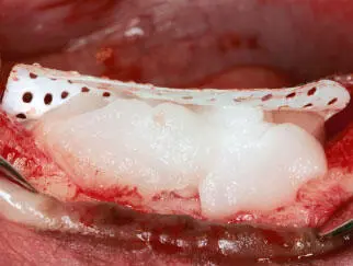 Fig 124 Bone morphogenetic protein2 BMP2 is bound into a collagen carrier - фото 29