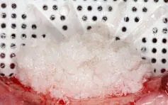 Fig 128 Labial view of a xenograft placed on a chronic vertical defect Fig - фото 33