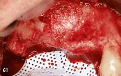 Vertical 2 The Next Level of Hard and Soft Tissue Augmentation - фото 118