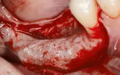Fig 121 Note the excellent cortical bone formation Dense versus perforated - фото 26