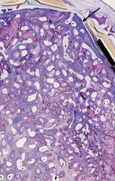 Fig 112 Image showing an area where corticalization has begun - фото 17