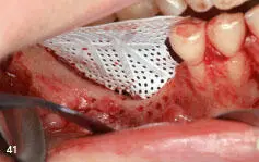 Figs 240 to 242 Vertical augmentation of the posterior mandible - фото 98