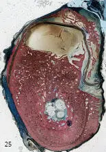 Figs 125 and 126 Crosssectional views showing bone formation in both groups - фото 30
